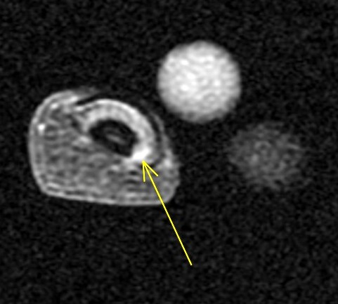 Figure 4 for case glomus tumor ( RID4513 )